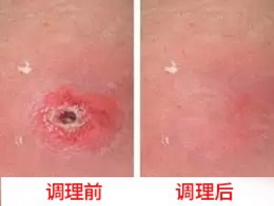 光神巴德尔BIOPTRON——治疗褥疮的研究报告