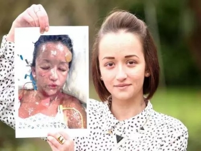 如今孩子10个有9个过敏，不敢乱用药的你，该了解光疗了！